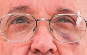 El ojo morado de Francisco item-thumbnail
